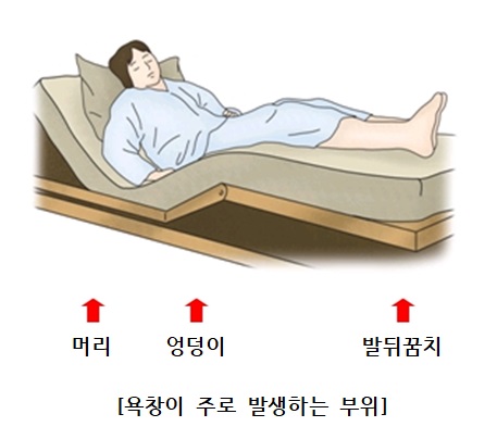 욕창이 주로 발생하는 부위