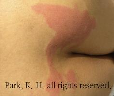 1단계 욕창 예시