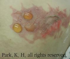 2단계 욕창 예시