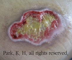 3단계 욕창 예시