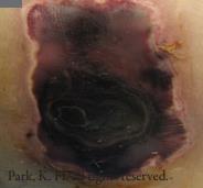 미분류 욕창 예시