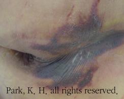 심부조직 욕창 예시